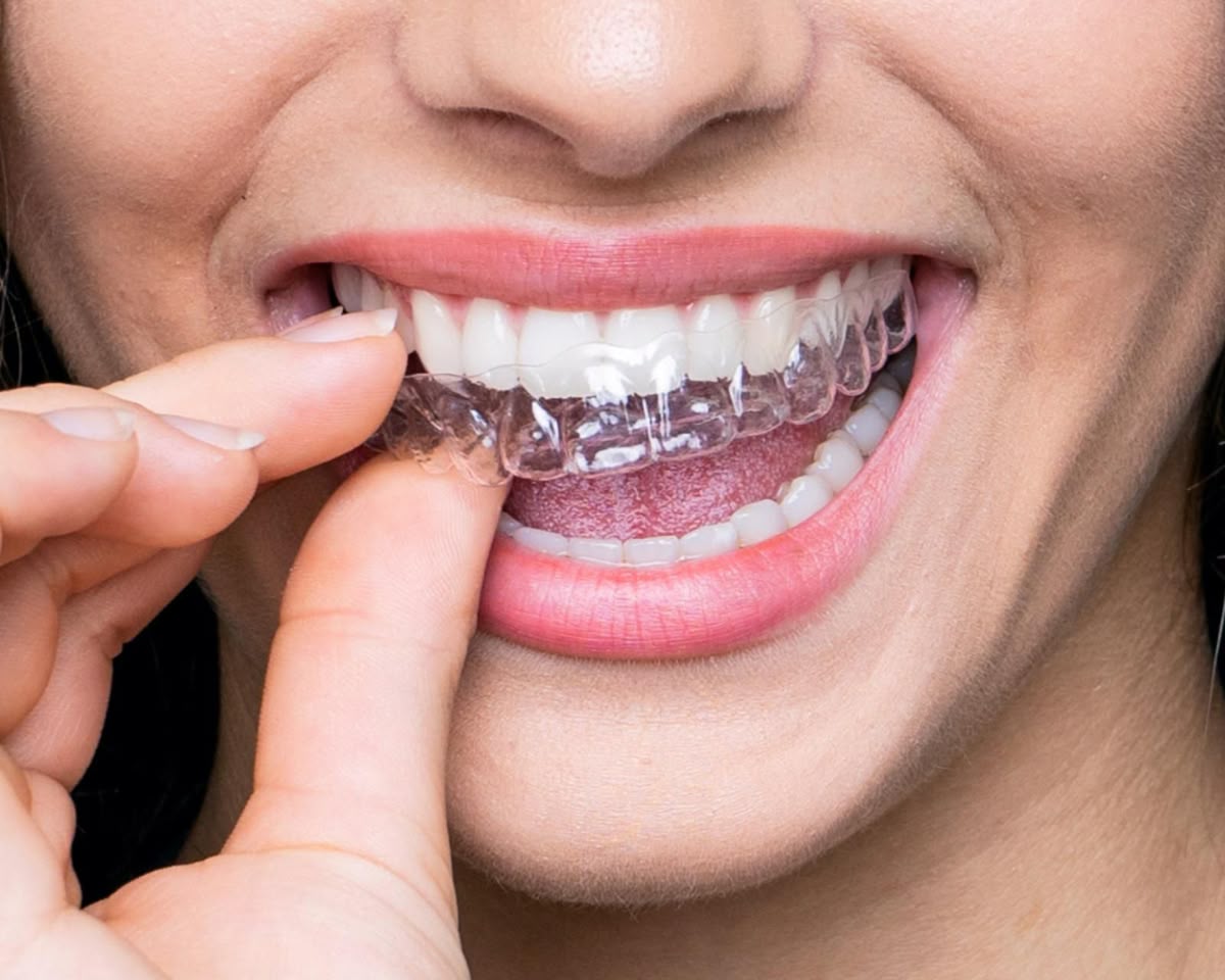 Clear Aligners