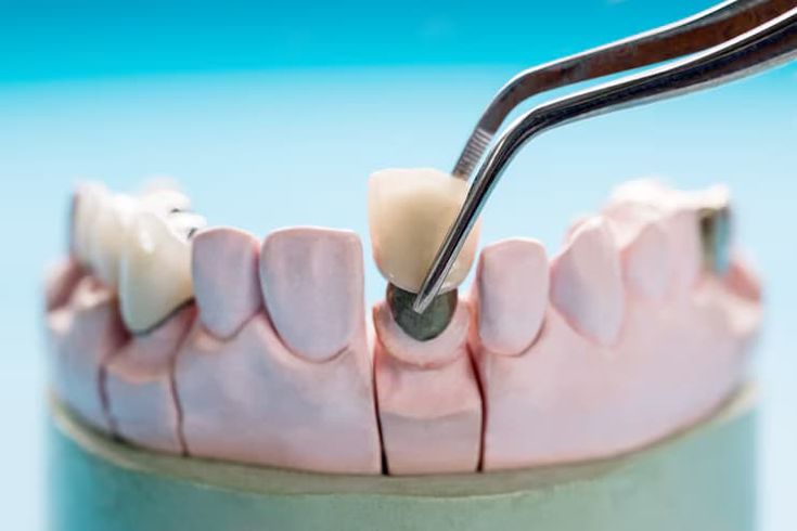 Dental Crowns