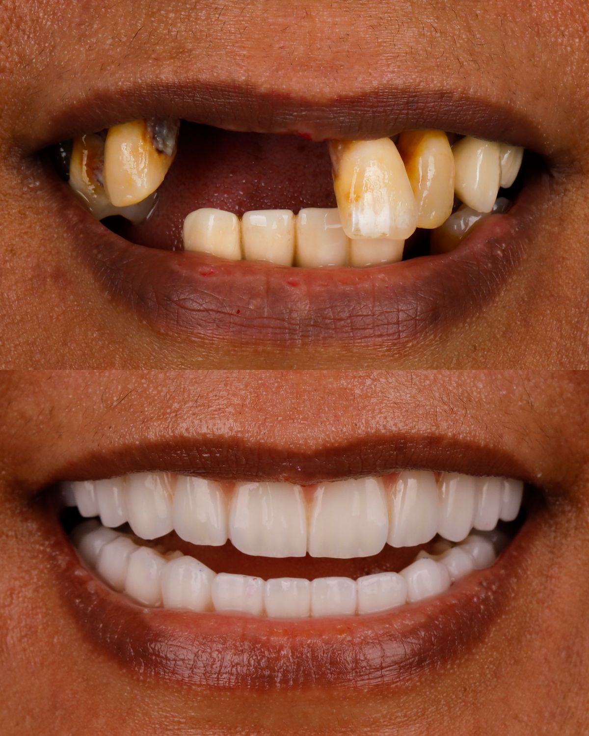 Smile Makeover