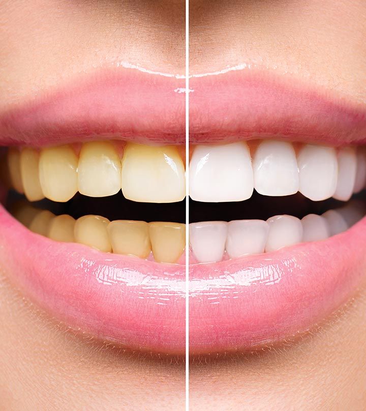 Teeth Whitening